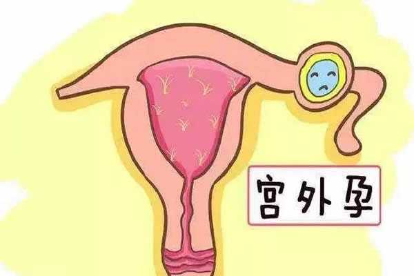 怎么取卵捐卵_试管婴儿宫外孕征兆有哪些，出现四个症状你可能宫外孕了